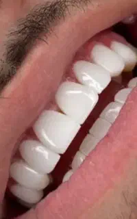 کامپوزیت فکی ۱۲عصبکشی با پرکردن۳۵۰۰(سنندج)