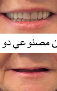 دندانسازی تخصصی ساخت دندان متحرک (اوردنچر)