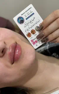 بوتاکس و فیلر لب به سبک mتکنیک و روسی و لیفتینگ