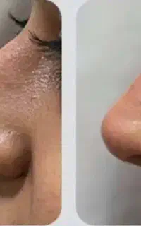 لیفت نخ فیلر بینی لیفت ابرو شقیقه صورت غبغب لاغری