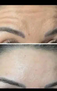 اموزش ژل بوتاکس انزیم