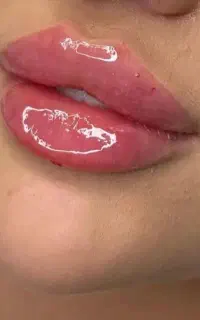 تزریق ژل و بوتاکس، تخفیف ویژه