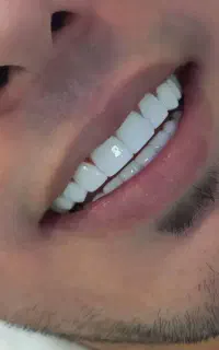 دندانپزشکی ، روکش، کامپوزیت