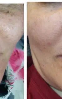 برای چین چروک  صورت پیری زود رس