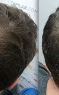 نیازی به کاشت نیست