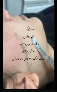 اصلاح درماپلنینگ.ورنگ ولایت