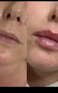 آموزش ژل و بوتاکس همراه با استخدام