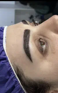 تخفیف و شرایط اقساط کاشت مو و ابرو
