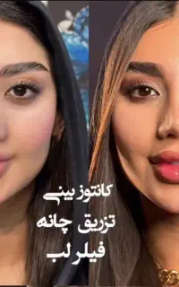 ژل تزریق بوتاکس هایفو  مزو۶۹۹