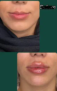 فیلر و ژل لب ، صورت و بدن ، دکتر اسدی صفا