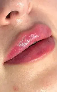 لیزر و ژل و بوتاکس