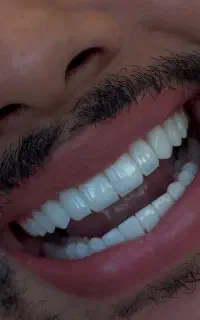 کامپوزیت دندان درجه یک