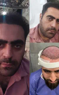 کاشت مو، ابرو و ریش در یزد /طراحی طبیعی و اختصاصی
