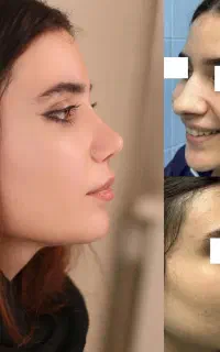 جراحی بینی ،تخفیف 50درصد در تهران