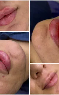 ژل و بوتاکس تخصصی