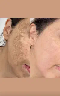 وایتنینگ تخصصی بیکینی و زیر بغل