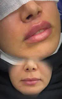 لیفت لب ها/سانترال لب/کاملا طبیعی و نچرال/اقساط