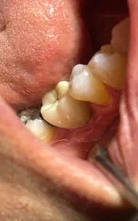 دندانپزشکی ایمپلنت، ونیر کامپوزیت، روکش، اطفال