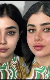 آف ویژه ژل وفیلرو بوتاکس به همراه اموزش