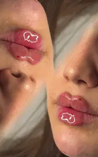 تزریق ژل لب بوتاکس پیرسینگ مادلینگ صورت مزوتراپی