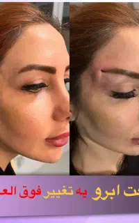 لیفت شقیقه صورت بلفاروپلاسی جراحی پلک پی آر پی