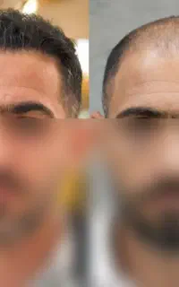 کاشت مو ریش و ابرو با ۳ میلیون