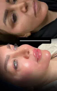 تخفیفات ویژه ژل و بوتاکس ورفع کک و مک ومزو وprp
