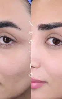 مینی لیفت ابرو