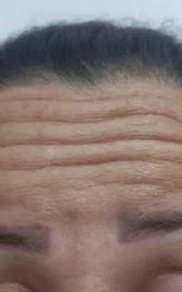 تزریق فیلر و بوتاکس. کاملا بهداشتی و استریل شده