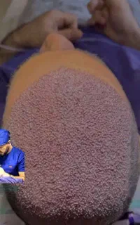 کاشت مو  کاشت ابرو مزوتراپی پی آر پی ژل و بوتاکس