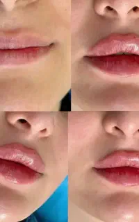 تخفیف ویژه فیلر رووفیل ۱۴۴۹ تومن + مشاوره رایگان