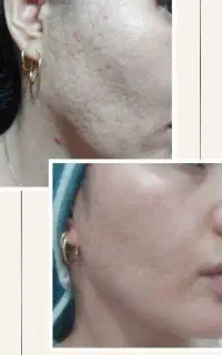 پاکسازی و فیشال پوست خانوم و اقا