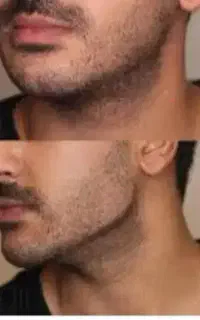 بوتاکس فیلر زیبایی
