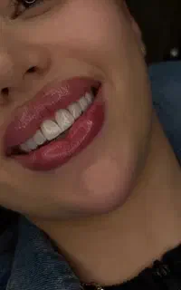 کامپوزیت و زیبایی دندان