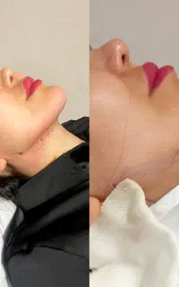 لابیاپلاستی/واژینوپلاستی/بلفاروپلاستی/ساکشن غبغب