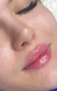 تزریق ژل و فیلر