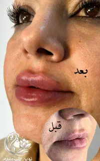 تزریق ژل و بوتاکس توسط پزشک با بازگشت هزینه
