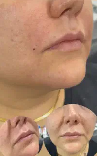 آموزش فیلر و بوتاکس