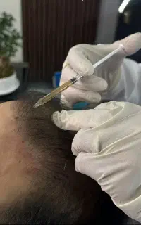 مزوتراپی و PRP ، هیرفیلر / مو و ابرو