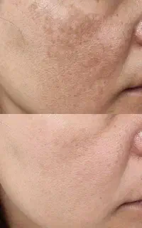 روشن کننده نواحی خصوصی بدن و تیرگی زیر بغل