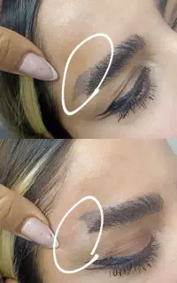 تخفیفات ریمو وپاک‌کردن تتو صورت وبدن