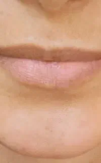 تزریق ژل .بوتاکس . مزوتراپی صورت و مو