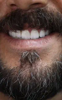 دندانپزشکی اقساطی ایمپلنت عصبکشی روکش قسطی