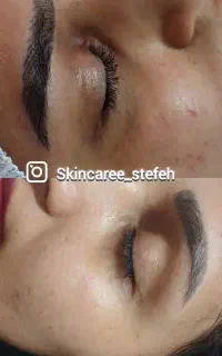 پاکسازی ، فشیال ، درمان مشکلات پوستی