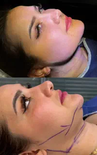 جشنواره سوپر کانتورینگ غبغب /لیزر /فیلر