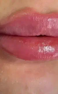 خدمات ژل و بوتاکس