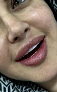 فیلر بوتاکس لیفت مزو توسط پزشک