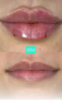 تزریق چربی و ژل با 5سال سابقه کاری