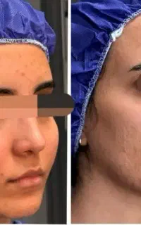 تزریق چربی صورت به صورت قسطی 15800