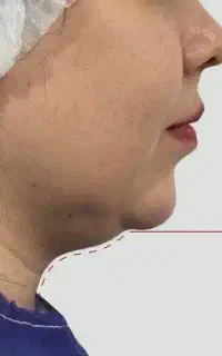 لیپوغبغب+خط کانتور+بوکال فت+اقساط